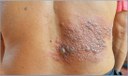 Dica-em-saude-herpes-zoster.jpg