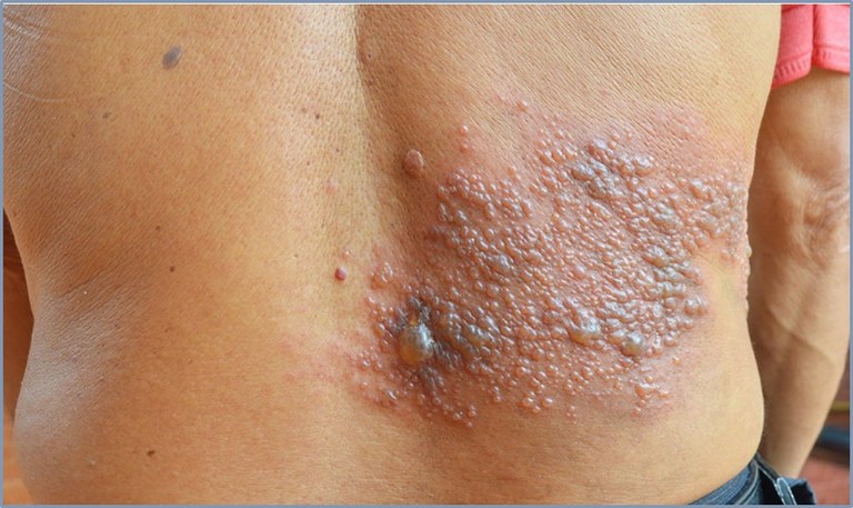 Dica-em-saude-herpes-zoster.jpg
