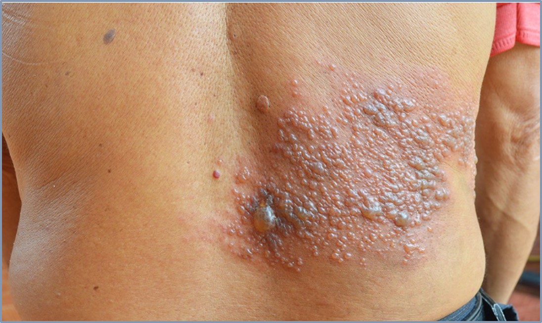 Dica-em-saude-herpes-zoster.jpg